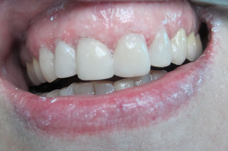 Реставрация зубов после